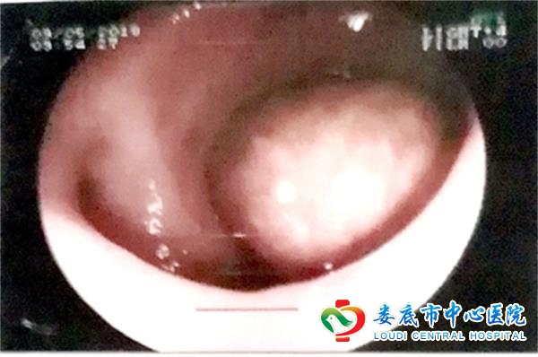 孟夏即事----胃石与可乐的“情缘”