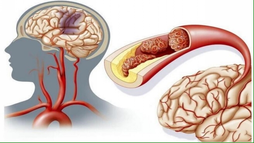 【健康科普】急性脑梗死治疗的“黄金钥匙”——静脉溶栓治疗